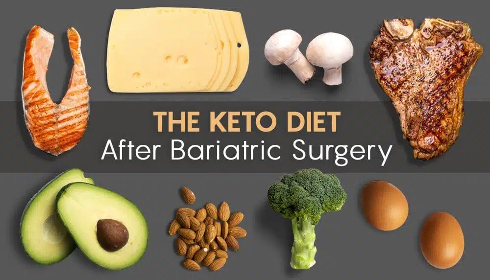 Keto diet for bariatric patients